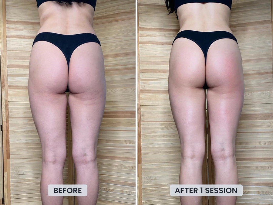 Smoother-looking skin after 1 session with Revimus Anti-Cellulite Massager