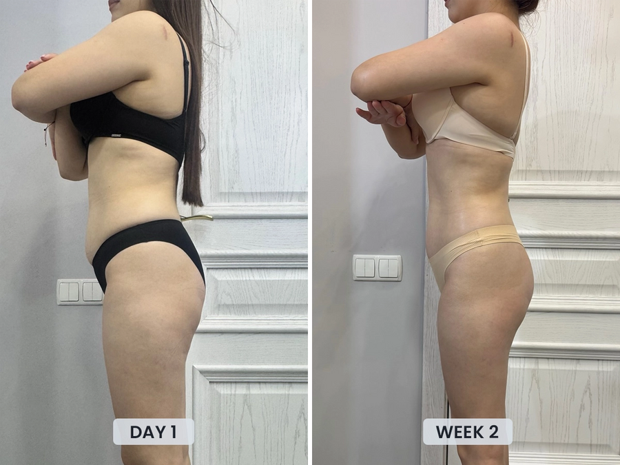 Early cellulite improvement after 2 weeks with Revimus Anti-Cellulite Massager