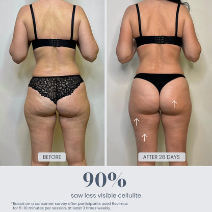 Before and after 28-day cellulite results using Revimus Anti-Cellulite Massager