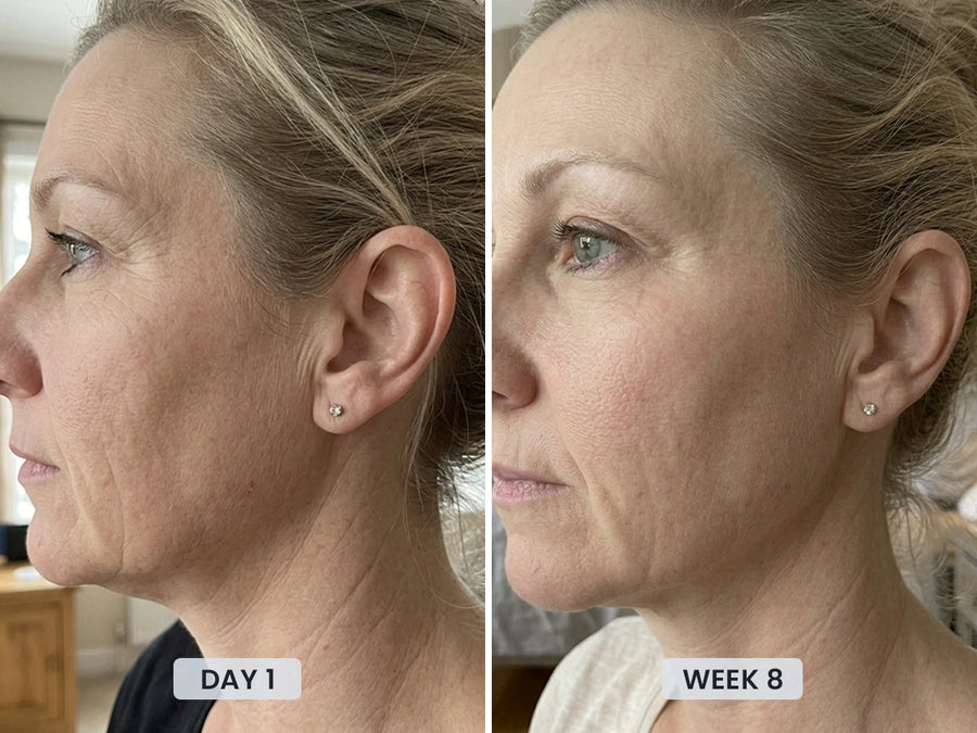 Visible improvement in facial contours and fine lines after 8 weeks using the Revimus LUMA Sculpting Wand
