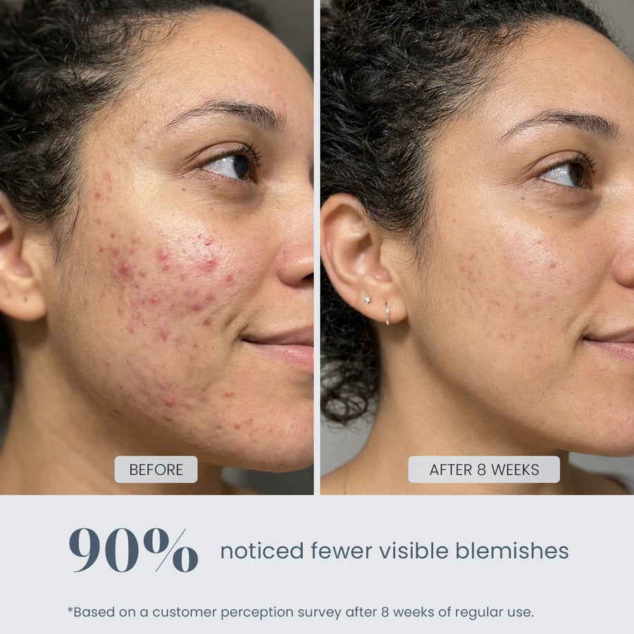 Before and after 8-week results showing fewer visible blemishes with REVIMUS ORBIT LED light therapy