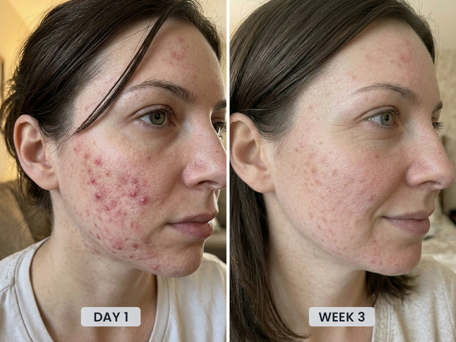 REVIMUS ORBIT™ before and after showing clearer-looking skin with fewer visible blemishes