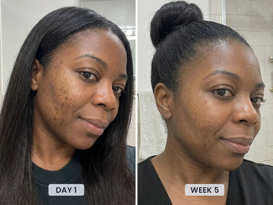 REVIMUS ORBIT™ before and after showing a brighter and more even-looking complexion