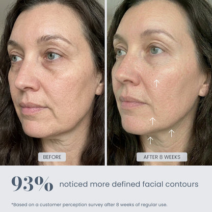 Before and after 8-week results showing more defined facial contours with REVIMUS ORBIT facial contour device
