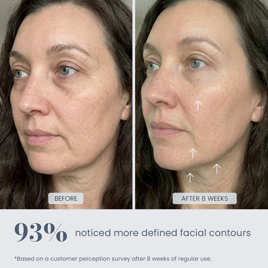 Before and after 8-week results showing more defined facial contours with REVIMUS ORBIT facial contour device
